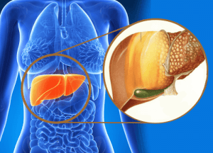1-fatty-liver-disease