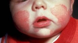 atopic dermatitis